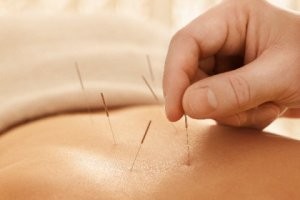 Acupuncture Needles