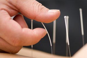 acupuncture_7